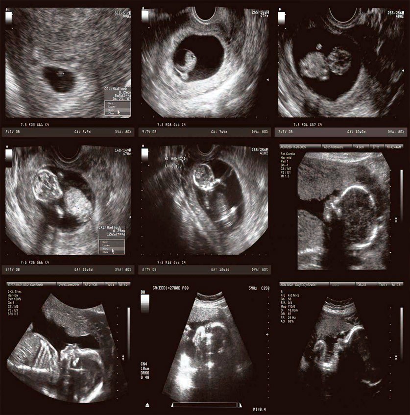 Prenatal Ultrason